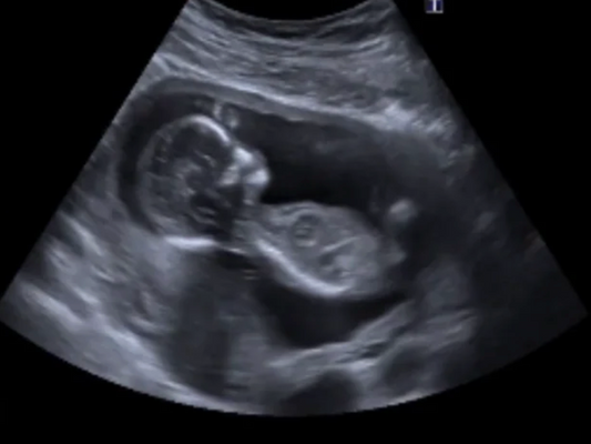 Our Journey to Pregnancy After Vaginismus